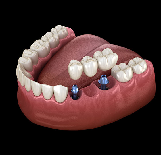 Dental-Crown-Image
