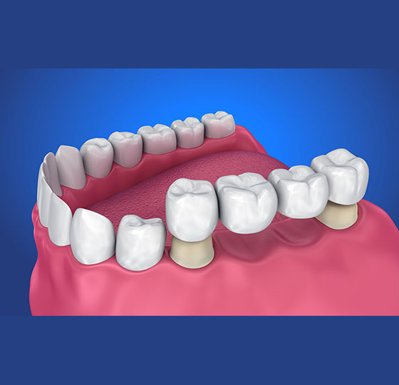 Dental-bridges-image