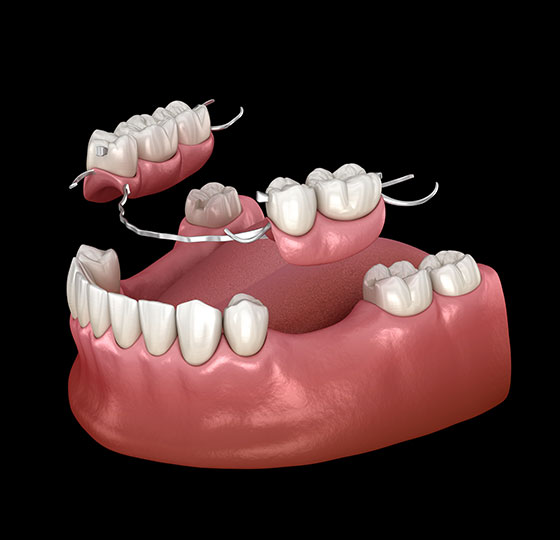Partial-and-full-denture