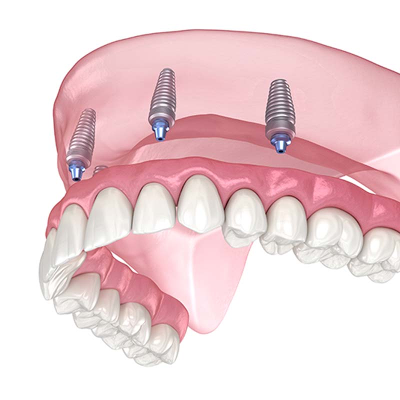 All-on-4 Dental Implants in Georgetown, TX
