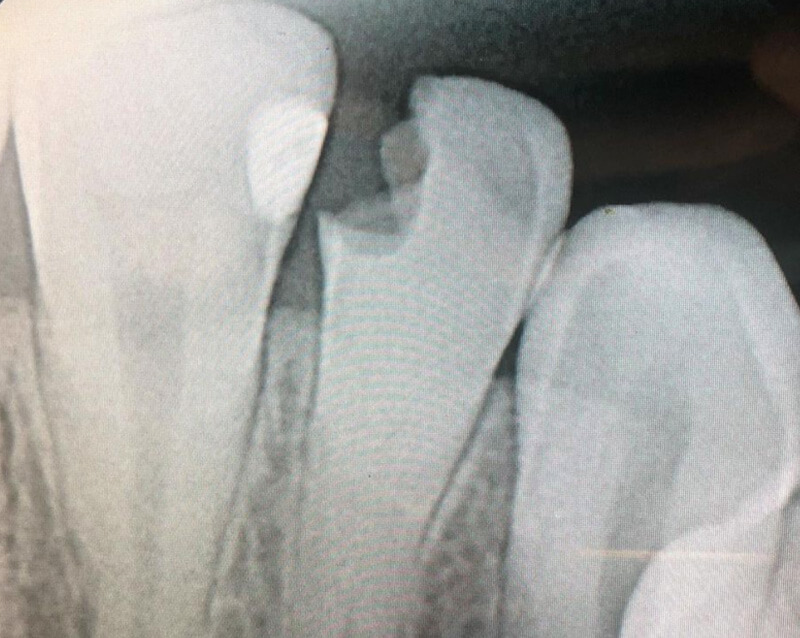 Root Canal - Case Study