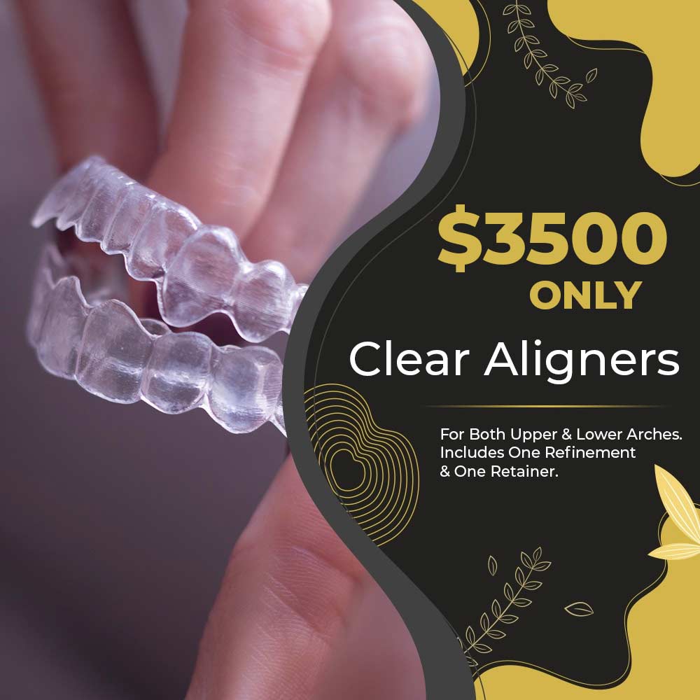 $3500 for clear aligners
